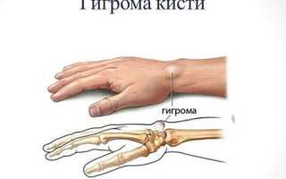 Гигрома на руке
