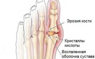 Подагра мазь
