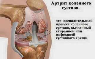 Артрит левого коленного сустава