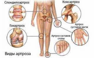 Лекарства при артрозе