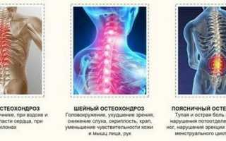 Остеохондроз как снять боль в домашних условиях