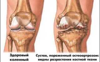 Остеоартроз коленного