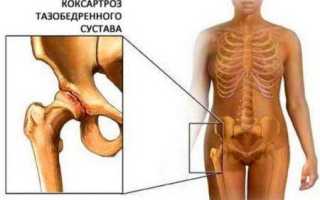 Левосторонний коксартроз 2 степени