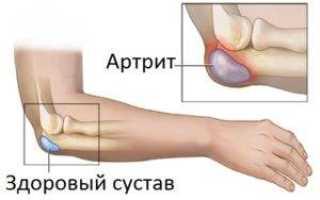 Профилактика артрита