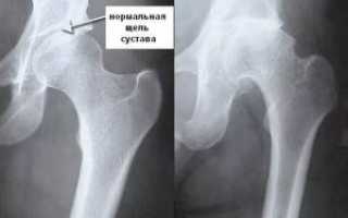 Деформирующий остеоартроз тазобедренного сустава 2 степени