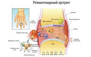 Схема лечения артрита