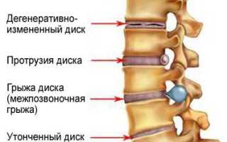 Что такое остеохондроз и как его лечить