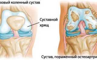 Артрит коленного сустава как вылечить