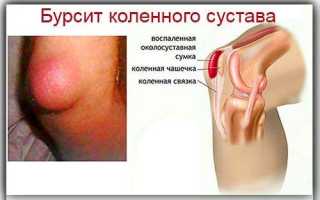 Синовит и бурсит коленного сустава