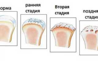 Артроз щиколотки лечение