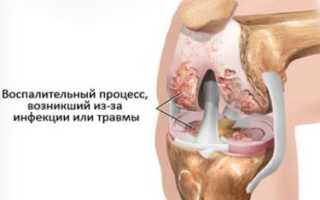 Что болит под коленкой сзади