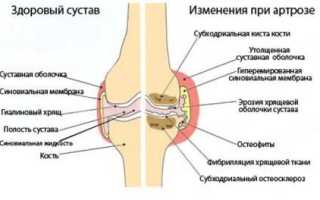 Артроз как его лечить