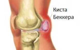 Как лечить кисту бейкера