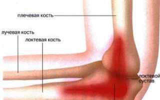 Боль в локтевом суставе связки