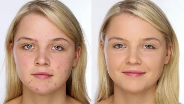 результат лечения