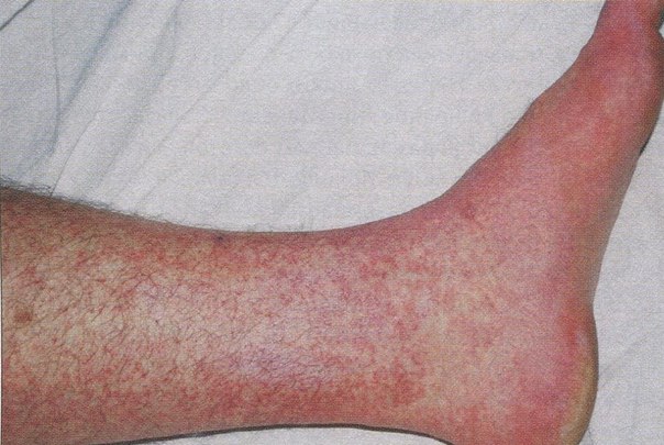 Паразиты Тайланда: виды и пути заражения