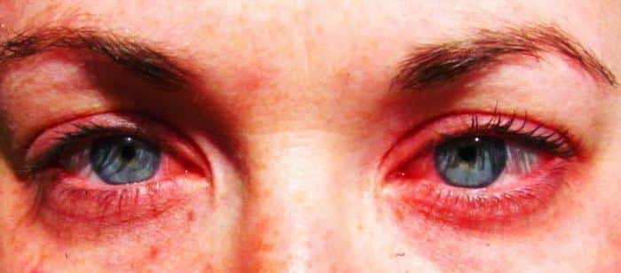 Симптомы демодекоза глаз