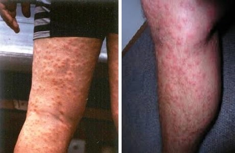 Церкариоз: определение заболевания, проявление, лечение и профилактика для купальщиков