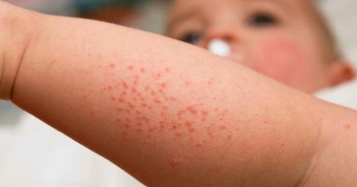 allergiya-na-glistov