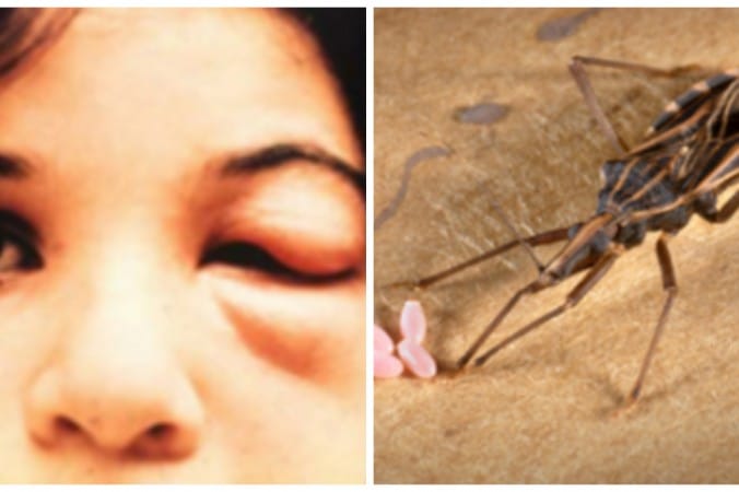 Как победить болезнь Шагаса: симптомы, диагностика, лечение