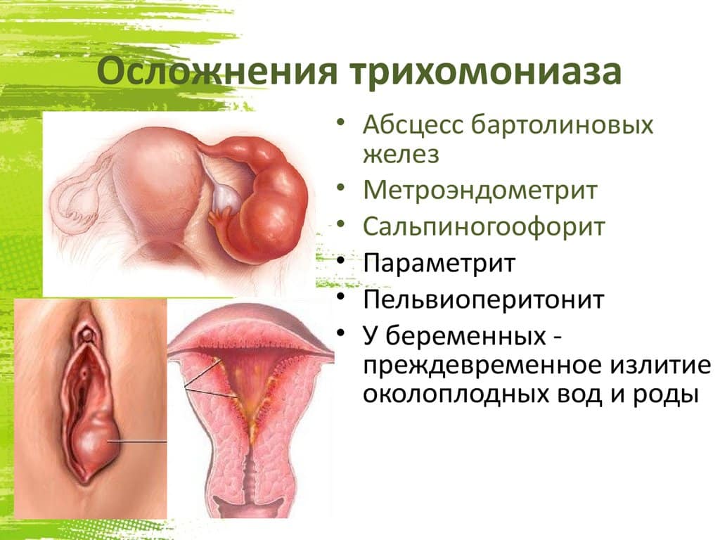 Чем опасен трихомониаз для женщин и для мужчин?