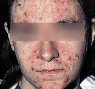 Как проявляются паразиты на лице?