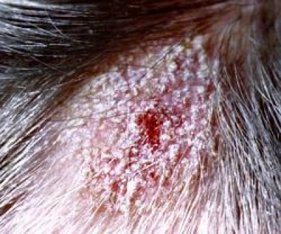 как выглядит болезнь