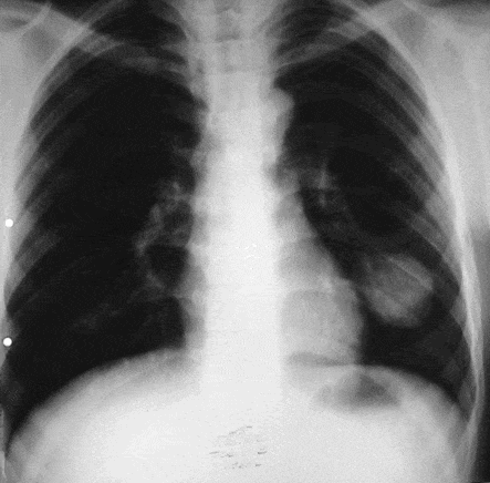 Как лечить эхинококкоз легких у человека
