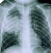 Что такое эхинококкоз