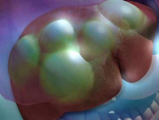 Что такое эхинококкоз