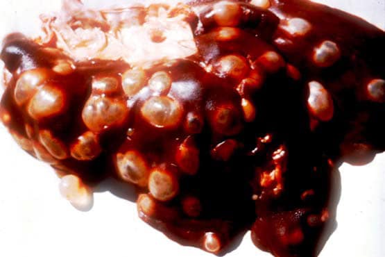 Эхинококкоз печени у человека и его лечение