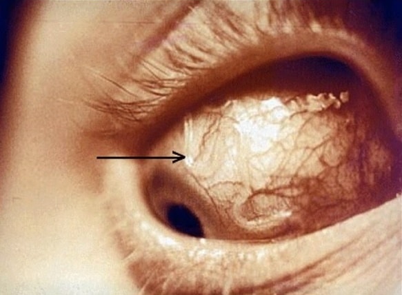 Филяриатоз: заражение, диагностика и лечение