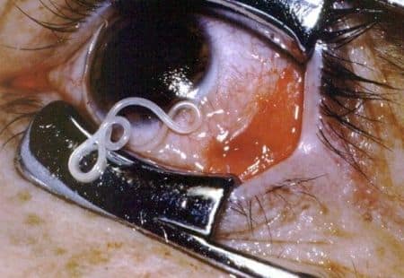 Паразиты в глазах человека: симптомы и виды заражений