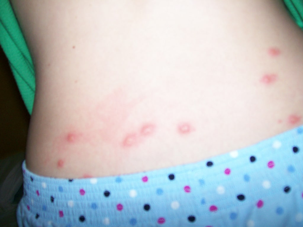 Укусы клопов