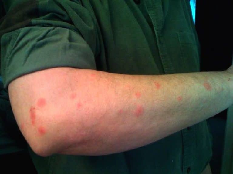 Укусы от постельных клопов: характеристики и способы лечения