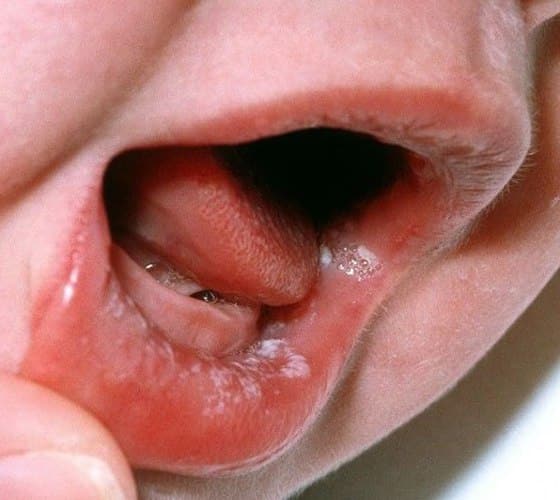 kandidoz-grudi-peredaetya-detyam