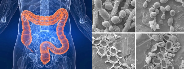 Кандидоз кишечника