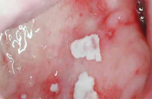 Вагинальный кандидоз