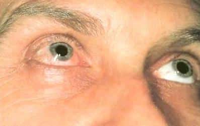 любые поражения глаз могут быть признаком патологии