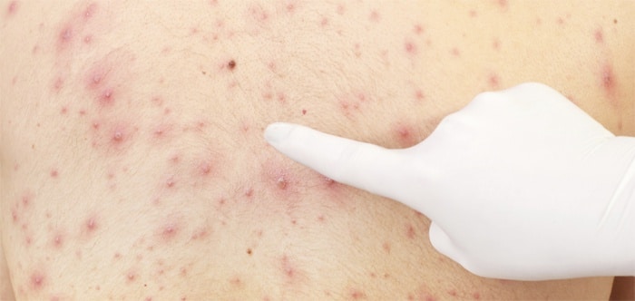 kozhnaya-sip-pri-glistah