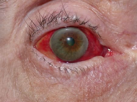 Паразиты в глазах человека: симптомы и виды заражений