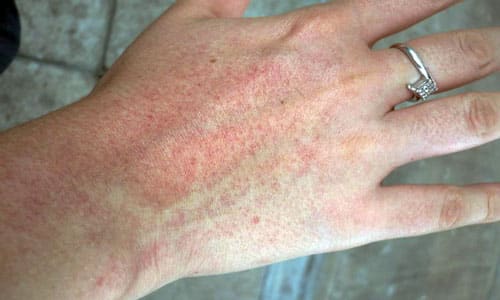 Бывает ли аллергия от глистов?