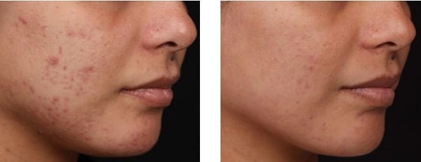 metrogil-gel-ot-demodekoza