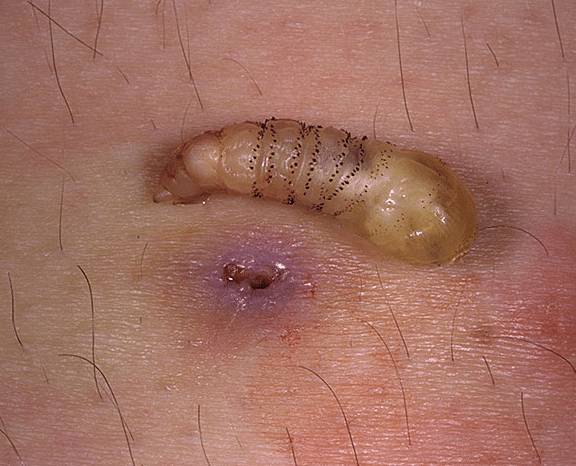 Что такое миазы у человека?