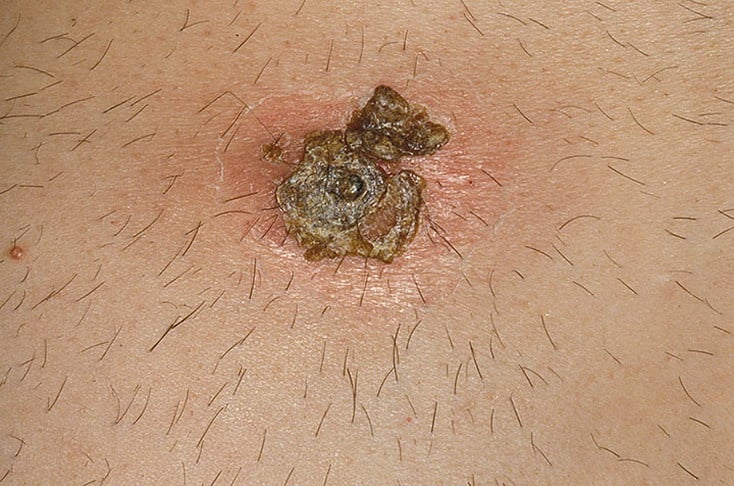 Что такое миазы у человека?