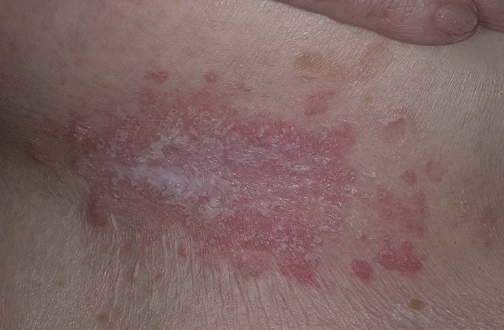 molochnitsa-pod-grudyu