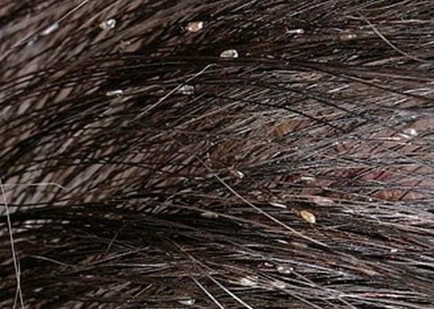 Основные мероприятия по профилактике педикулеза