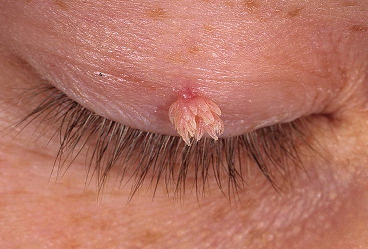 Как и от каких паразитов появляются папилломы?