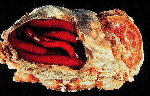 Как лечить паразитов в почках?