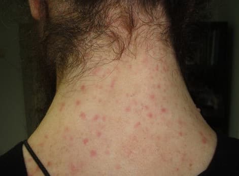 Как определить и вылечить педикулез